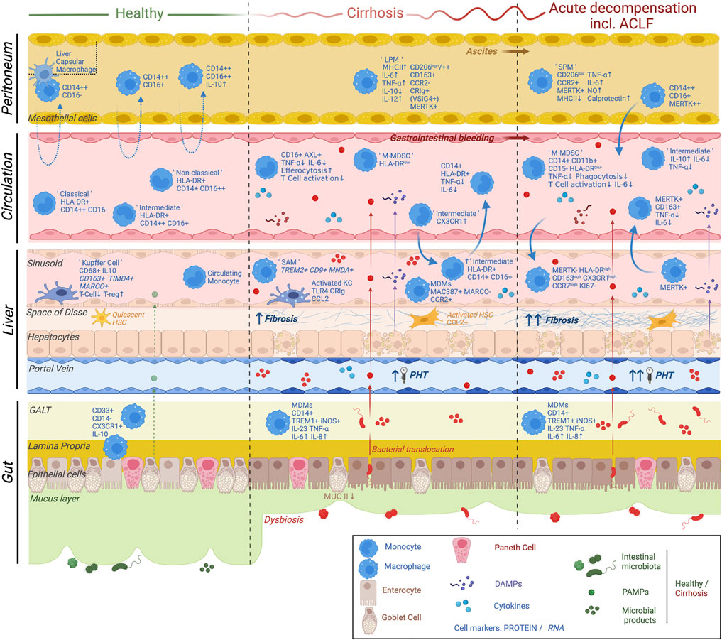 Plasticity of monocytes and macrophages in cirrhosis of the liver